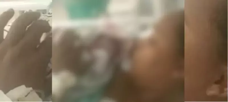 Criança recém-nascida tem cabeça cortada durante parto em Joinville