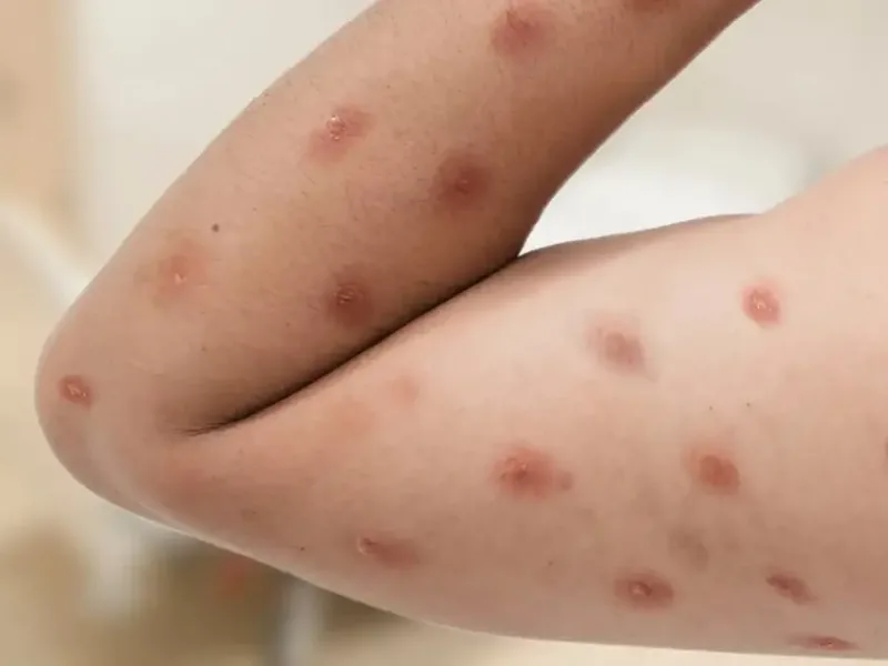 Ministério da Saúde confirma 140 casos de Mpox no país, em 2026