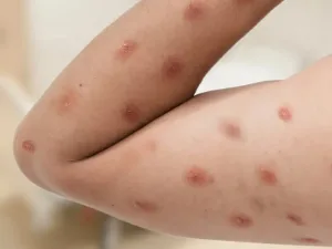 Ministério da Saúde confirma 140 casos de Mpox no país, em 2026